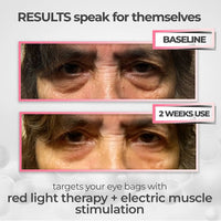 Vive™ 2-in-1 Red Light Therapy + EMS To Erase Eye Bags
