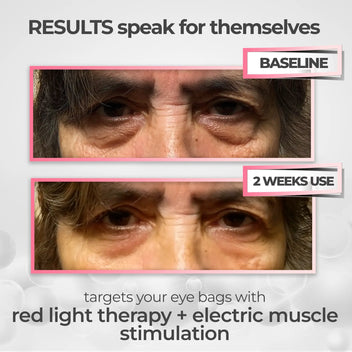Vive™ Terapia de luz roja + EMS 2 en 1 para eliminar las bolsas de los ojos