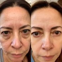 Vive™ 2-in-1 Red Light Therapy + EMS To Erase Eye Bags